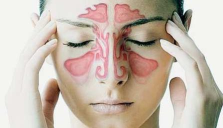 sinusitis