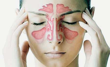 sinusitis